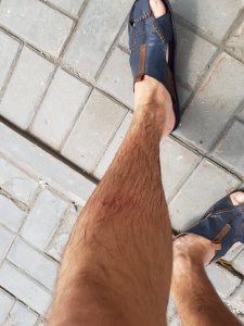 Горожанин повредил ногу в яме на Московской